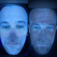 UV skin consultation scan comparison